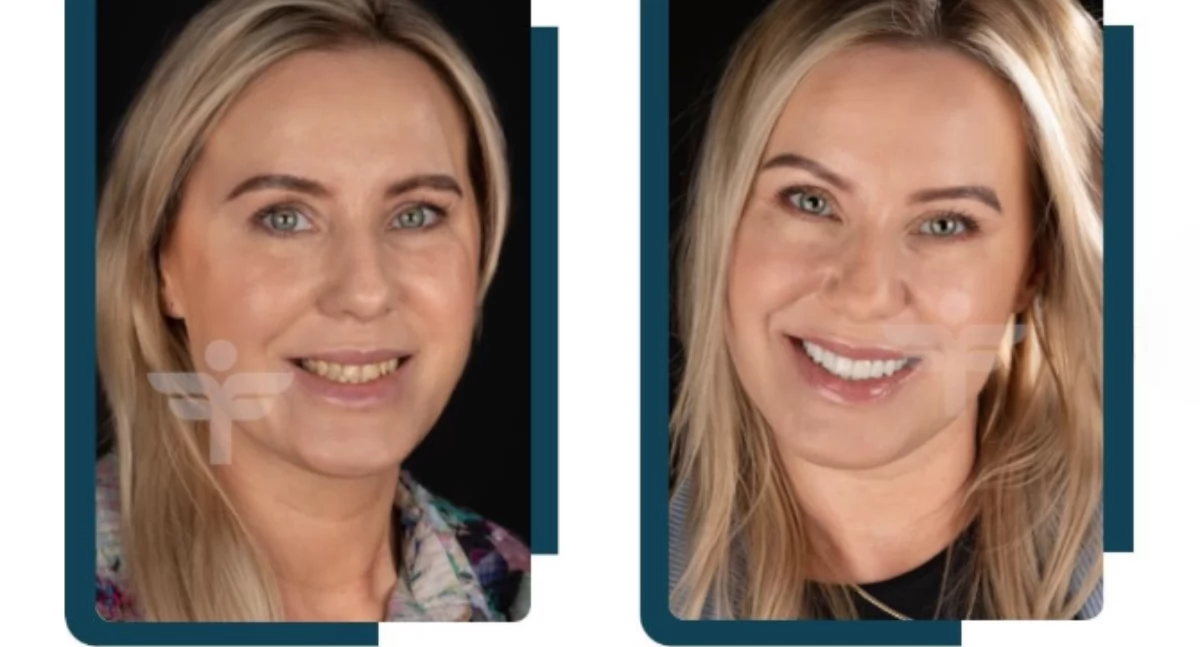 Zdrowie, Uśmiech czerwonego dywanu właściwie Hollywood Smile - zdjęcie, fotografia