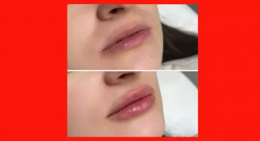 Powiększanie ust - nowoczesne metody, naturalny efekt i personalizacja zabiegów w medycynie estetycznej we Wrocławiu